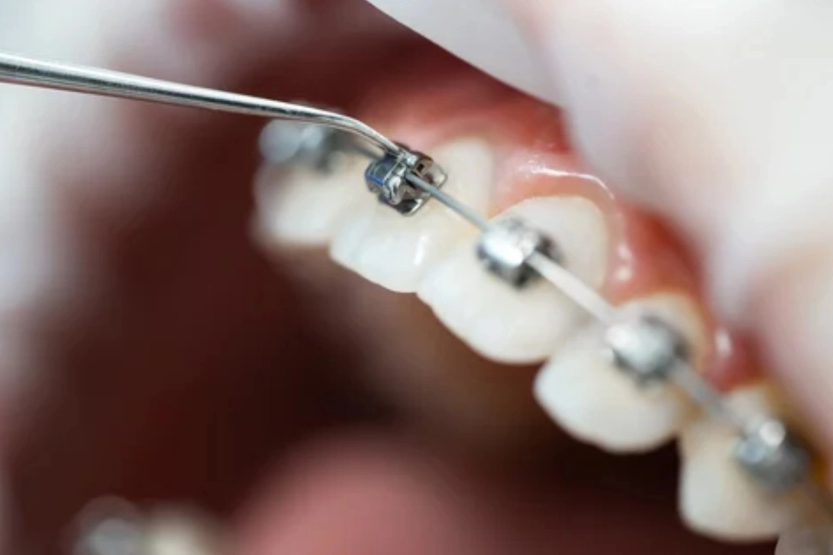 Brackets Las Condes 2 Intalacion Ortodoncia las condes • Ortodoncia Digital